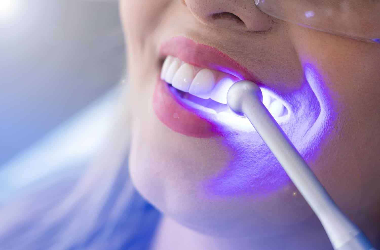 professional teeth whitening in Albania