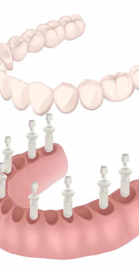 advanced full arch replacement with all on 8 implants in Albania