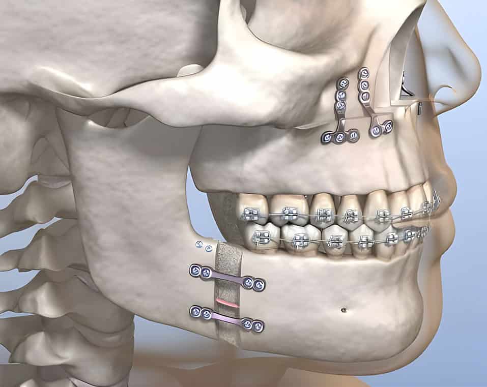 affordable Orthognathic Treatment in Albania