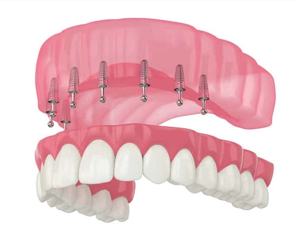 affordable all on 8 implants in Albania