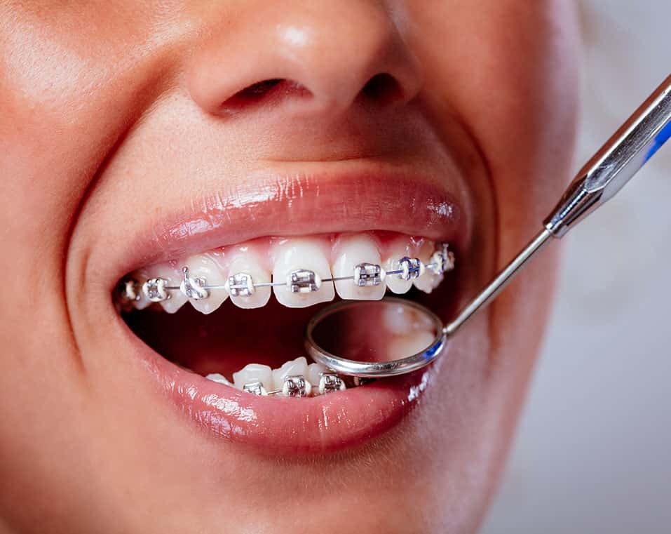 affordable braces in Albania