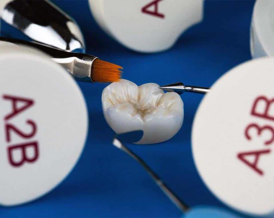 affordable dental crowns in Albania