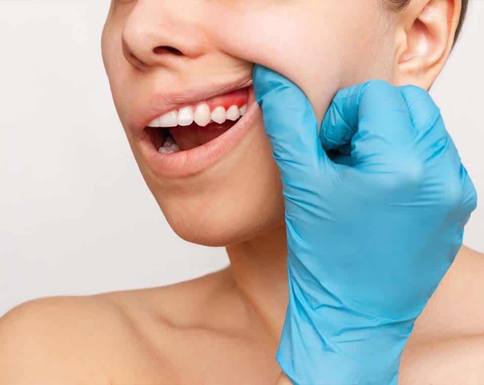 affordable gum lift in Albania