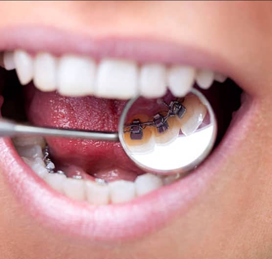 affordable invisible lingual braces in Albania