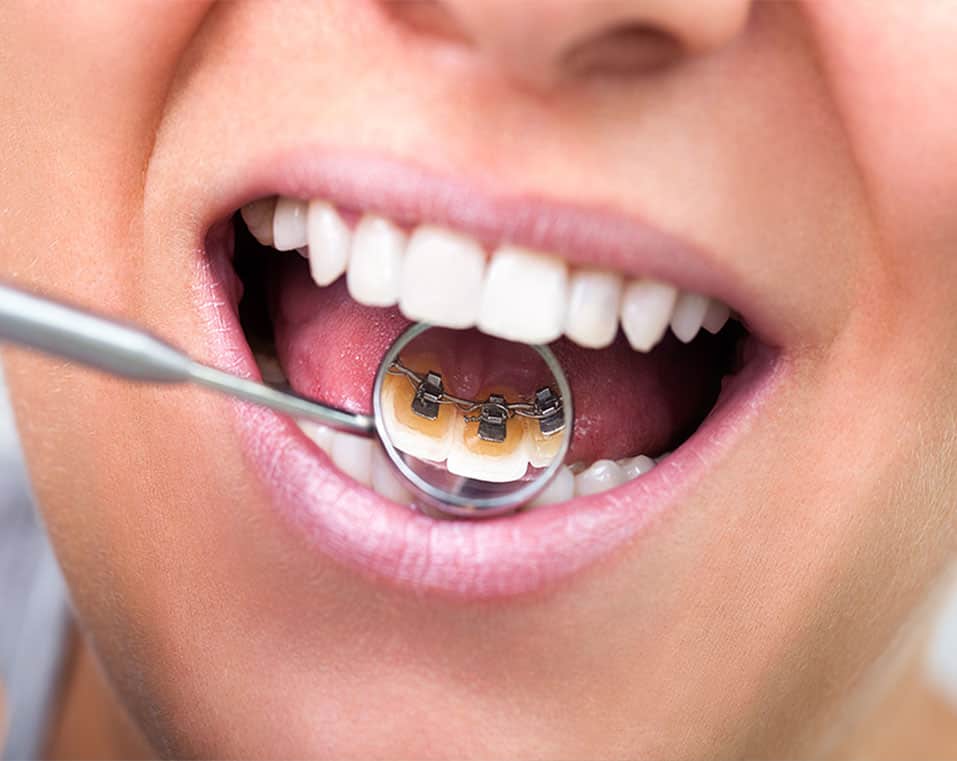 affordable lingual braces in Albania