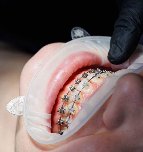 affordable orthodontic braces in Albania
