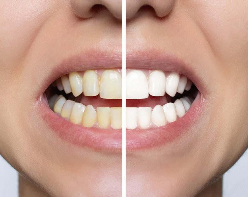 affordable professional teeth whitening in Albania