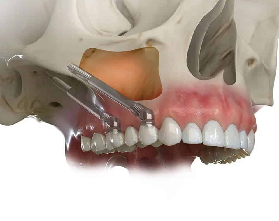 affordable pterygoid implants in Albania