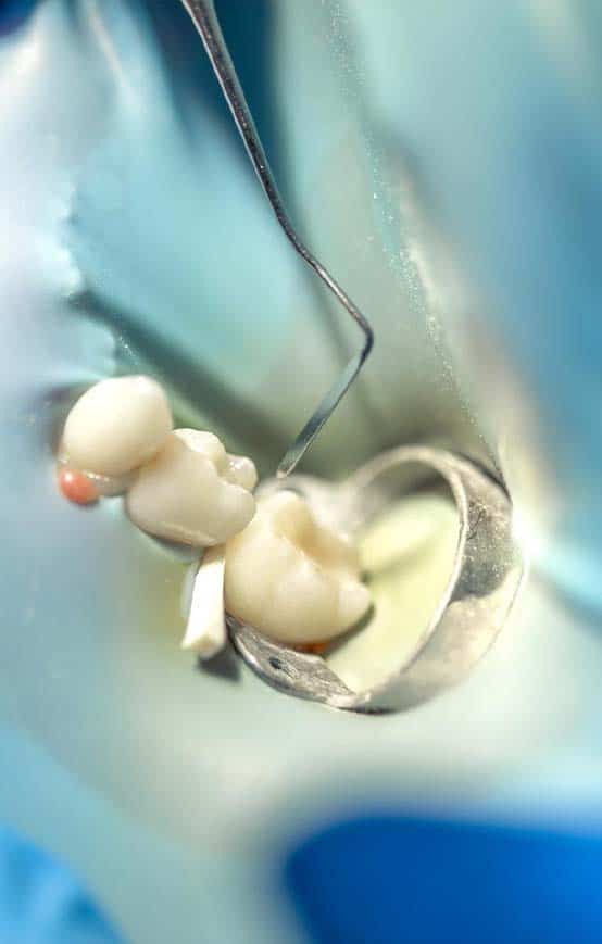 affordable tooth restoration with dental crowns in Albania