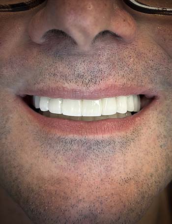 amazing dental implant in Albania results