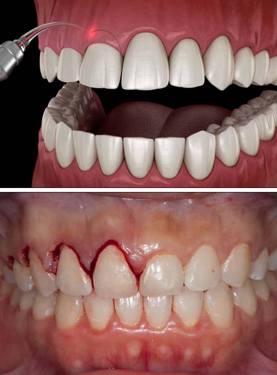 amazing results after gum lift in Albania