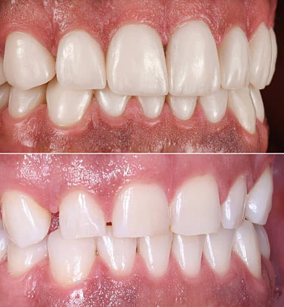 amazing results before and after Invisalign in Albania