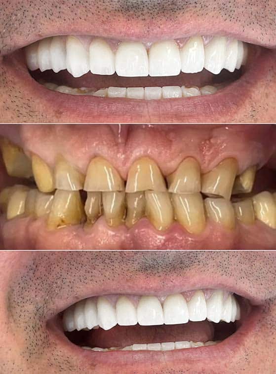 amazing results before and after dental crowns in Albania