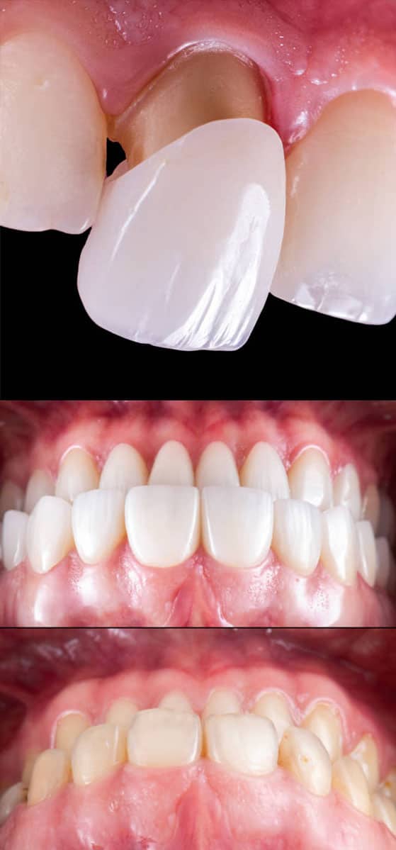 amazing results before and after dental veneers in Albania