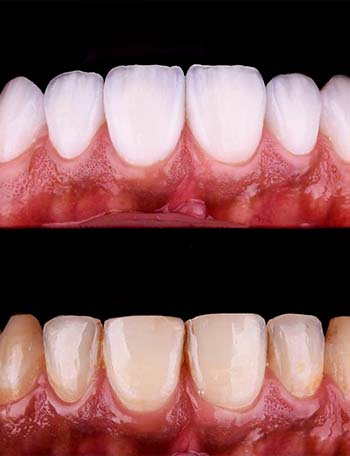 amazing results dental crowns in Albania