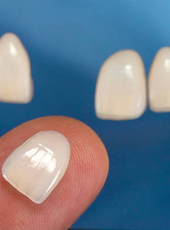 dental veneers in Albania