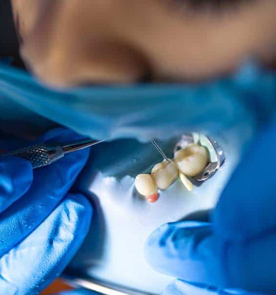 durable dental fillings in Albania