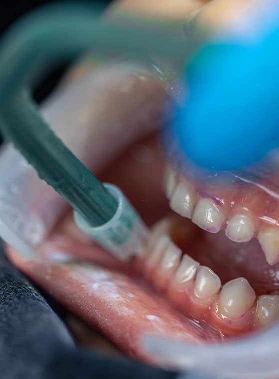 gum treatment in Albania