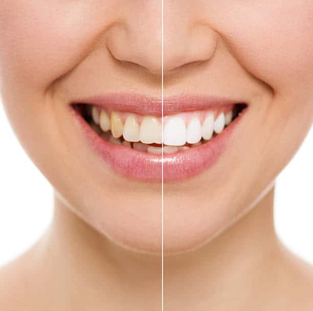 before and after dental veneers in Albania