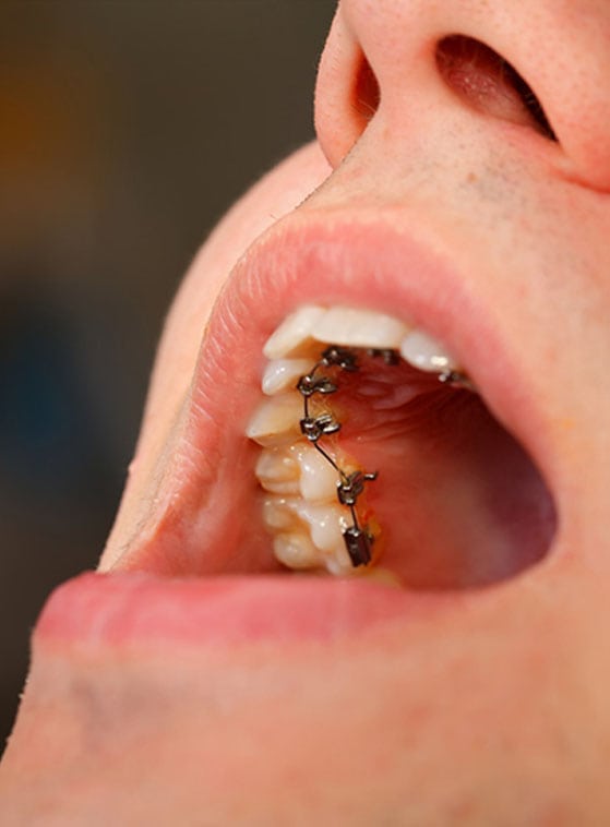 lingual braces in Albania