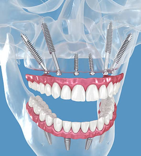 pterygoid implants in Albania for patients with bone loss