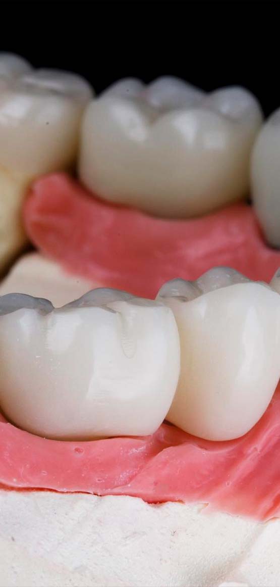 tooth replacement with dental bridges in Albania